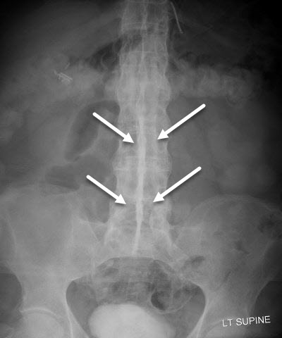 Dagger Sign of Ankylosing Spondylitis